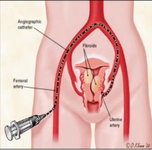 子宫动脉栓塞手术示意图.jpg